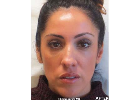 Before and After Treatment Result