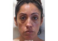 Before and After Treatment Result